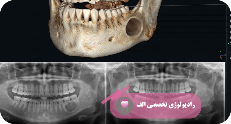 تصویربرداری ضایعات فک و صورت؛ بررسی کیست، تومور و ضایعات استخوانی | رادیولوژی الف